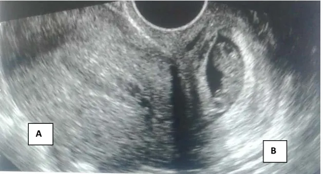 Figure 1. Ultrasound aspect. A: Empty uterus with a thickened endometrium; B: Left extra uterine mass