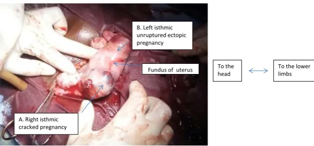 Figure 2. Per operative view of bilateral ectopic pregnancy. A: Right isthmic cracked pregnancy (site of molar pregnancy); B: Left isthmic unruptured ectopic pregnancy