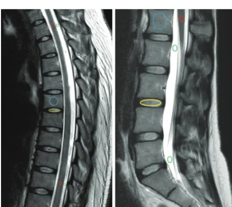 FIG 1. Conventional T2WI (A) and quantitative T1 (B), T2 (C), and PD (D) maps in a cervical study.ROIs are placed in the CSF (green), spinal cord (red), intervertebral disc (yellow), and vertebralbody (blue).