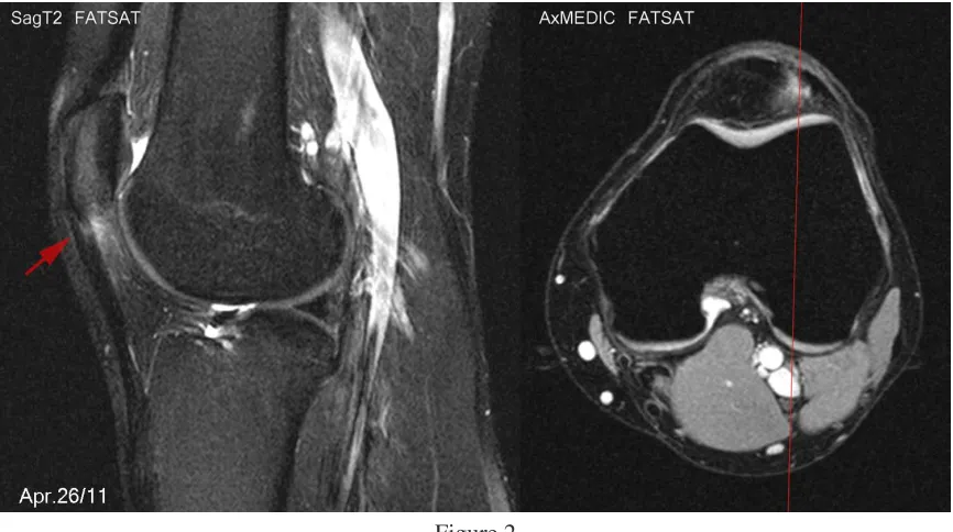 Figure 2 A second MRI (T2 weighted) that revealed an increase in size of the patellar tendon defect 