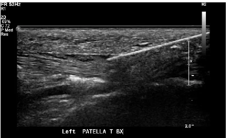 Figure 3 Platelet rich plasma injection with a fat graft into the patellar tendon guided by 
