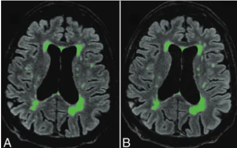 FIG 4. Automatic postprocessing performed with Quantib Brain 1.2software allowing the assessment of MS lesion volumes using CS (A)and conventional FLAIR (B)