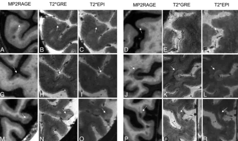 FIG 1. Comparison of cortical lesion detection with MP2RAGE and T2* weighted sequences at 7T