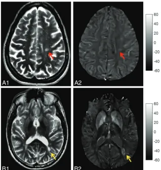 FIG 1. Top panel, Example of rim� lesion (red arrow): T2-weighted image (A1) and QSM (A2) in apatient with relapsing-remitting MS