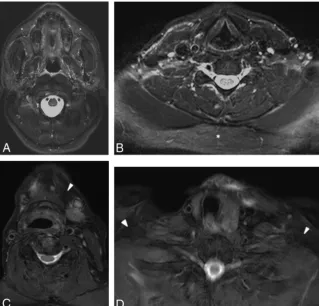FIG 3. Axial STIR (suppression (complete uniform fat suppression (A and B) and mDixon T2-weighted (C and D) MR images