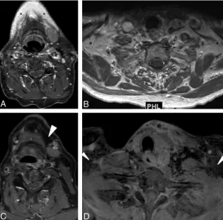 FIG 5. Gadolinium-enhanced coronal T1-weighted MR images withSPIR (A) and mDixon (B) techniques for fat suppression