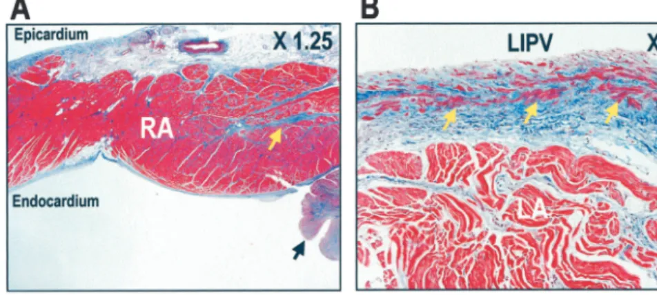 Figure 6. Trichrome stain of atria. A, Focal fibrosis (dog 5). Pacing site is to right of this panel