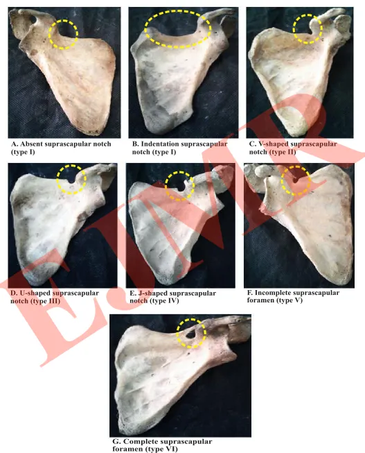 Fig 3: Showing The Various Shapes Of Suprascapular Notch.