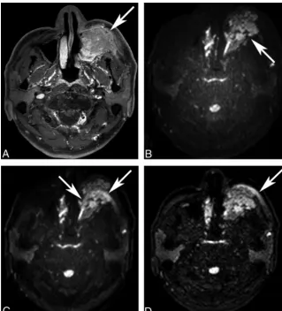FIG 1. Fat-suppression uniformity of DWI. A 49-year-old man underwent MR imaging for stagingof left maxillary sinus cancer (A, post-contrast-enhanced T1WI, arrow)