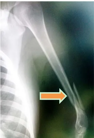 Figure 1. Preoperative X-ray image. An upper left arm com-plex fracture of the bone is shown (arrow)
