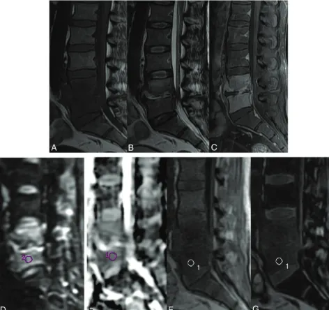 FIG 1. A 35-year-old man with biopsy-proved vertebral tuberculosis shows diffusely hypointense signal in the L4 and L5 vertebrae on sagittalT1WI (A) and hyperintense signal on sagittal T2WI (B)