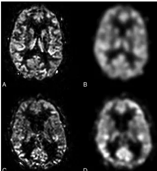 FIG 2. Example of ASL perfusion maps from a healthy control without (A) and with (B) smoothing,as well as from a patient with iNPH without (C) and with (D) smoothing.