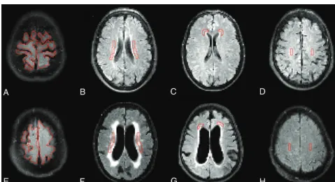 Table 1: Cerebral blood ﬂow values in patients and controlsa