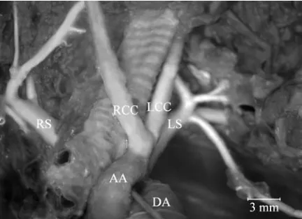 Figure 3. Single trunk for common carotid artery and brachio-cephalic trunk. AA — arch of the aorta, DA — BT + LCC — single trunk for the common carotid artery and bra-ductus arteriosus,chiocephalic trunk, LS — left subclavian artery.
