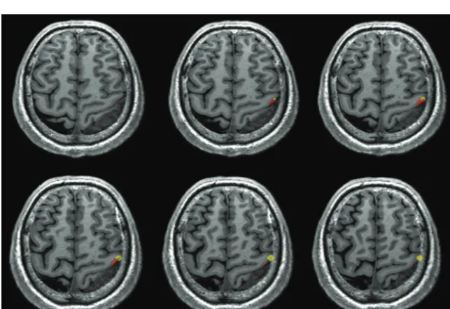FIG 3. An example of the nonoverlapping phenomenon (patient No. 9). There was no regionoverlapping between the BOLD fMRI and DCS results