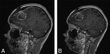 FIG 2.Sagittal postcontrast MPRAGE images from a 53-year-oldwoman with history of breast cancer showing postoperative ﬁndingsafter resection of a brain metastasis