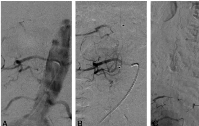 FIG 4. 75-year-old man (patient 11) with a right L3 spinal dural arteriovenous ﬁstula (SDAVF) and 3venous shunt supplied by a right L3 radiculomeningeal branch and draining into a right L3 radicu-lomedullary vein (prior negative angiograms