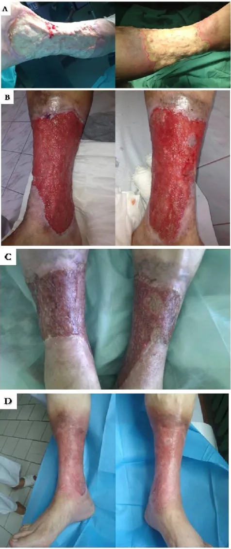 Figure 2. Patient no. 12 in Table 1; a) wounds of both legs at the momentof admission; b) the wounds bed ﬁlled with granulation tissue after 20 daysof NPWT; c) the wounds at the moment of discharge from the hospital; d)the wound 2 months after discharge from the hospital