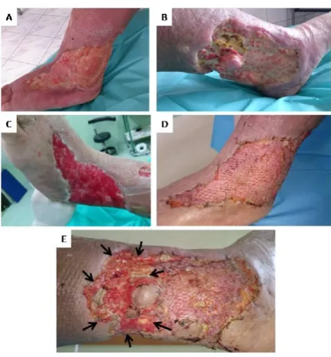 Figure 4.Patient no. 14 in Table 1; a,b) the wounds at the moment ofadmission; c) the wounds bed ﬁlled with granulation tissue after 13 days ofNPWT; d, e) healing of only 70 % of applied skin grafts, regrafting wasneeded on the marked area (black arrows).