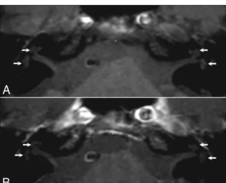 FIG 2. Inﬂammatory pattern in a 35-year-old man with right SSHL. The precontrast T1-weightedsignal in the right cranial nerves VII and VIII and in the middle and upper turns of the left cochlea.A postcontrast T1-weighted sequence (3D-FLAIR sequence (sequen