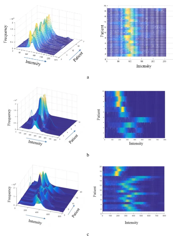 Figure  4-16(c)  (high-grade).  Therefore,  the  MRI  image  histogram  normalisation  stage  is  essential