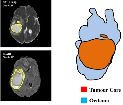 Figure  2-15  shows  sample  of  tumour  tissues,  which  are  overlapped  on  FLAIR  and  p-map  protocols
