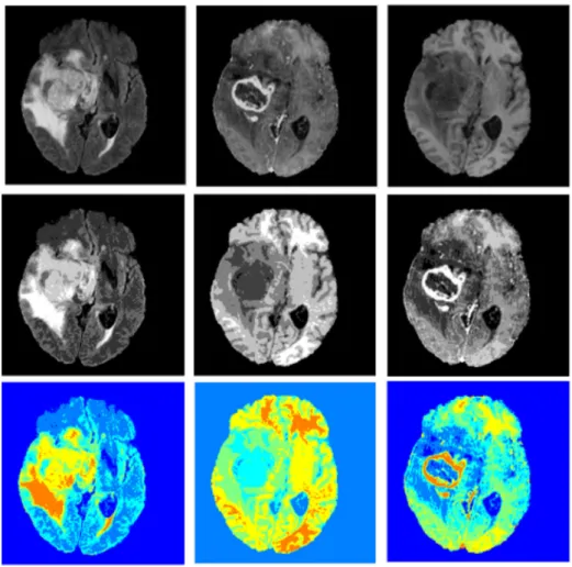 Fig. 8 (top to bottom row): Original MR images (FLAIR, T1ce, T2),quantized images using 5 thresholds, quantized image using 5 thresholds but with RGB labeling