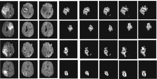 Fig. 11 (left to right), FLAIR, T1ce and T2 MRI modalities, ground truth, CIFAR, CIFAR DT, CIFAR PI DT and CIFAR PI HIS DT segmentation masks
