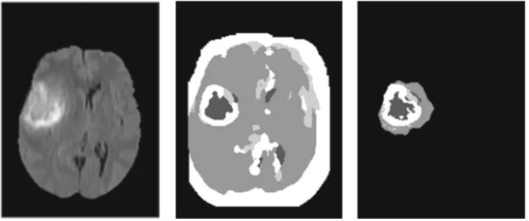 Fig. 4 (left to right) an original MR image, the result with randomly patch selection and the result with control patch selection