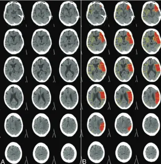 FIG 3. Example of a patient with extensive early signs of ischemic damage on the baseline NCCTA)