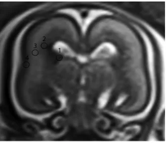 FIG 1. Sagittal T2 midline images of fetuses. Examples provide thebut ill-deﬁned contour.visible structure.structure.qualitative assessment of the primary ﬁssure of the cerebellum(arrows)
