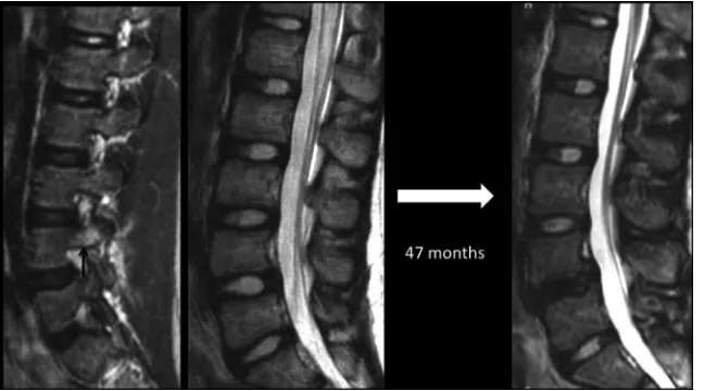 FIG 3. Sequential MR images of the lumbar spine showing the evolution of lumbar disceration at baseline
