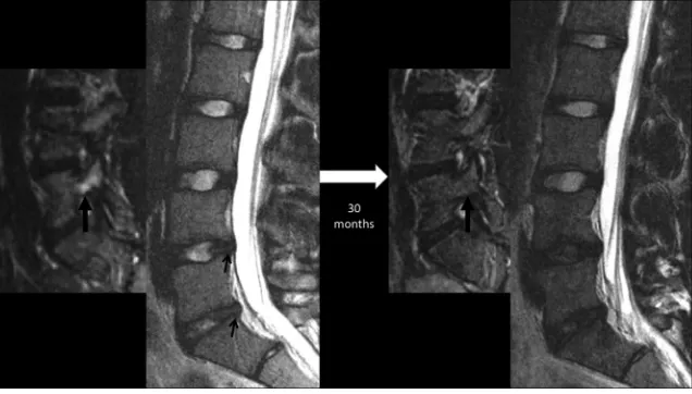 FIG 5. Sequential lumbar MR images obtained 30 months apart in a 15-year-old male patient witheration at the L5–S1 level