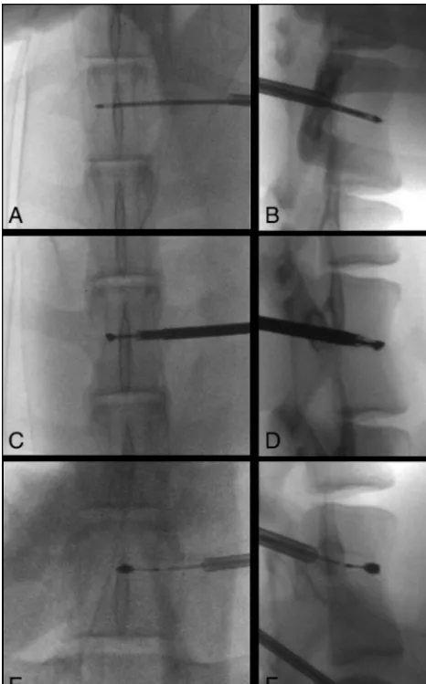 Table 2: Technical parameters used for cryoablation, expected minor-axis diameter of theablation zones based on nonanimal models, and measured ablation zone diameters on MRIand gross pathology