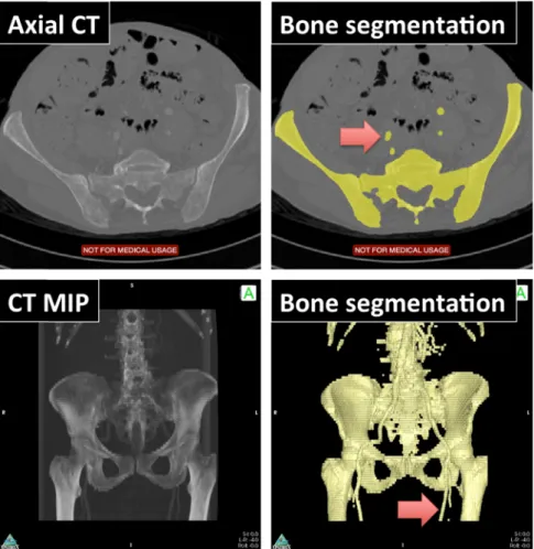 Fig. 5. Automatic segmentation of CT angiogram in the pelvis. Top: segmentation results, displayed axially using a yellow brush ROI, demonstrate excellent delineation of the bone