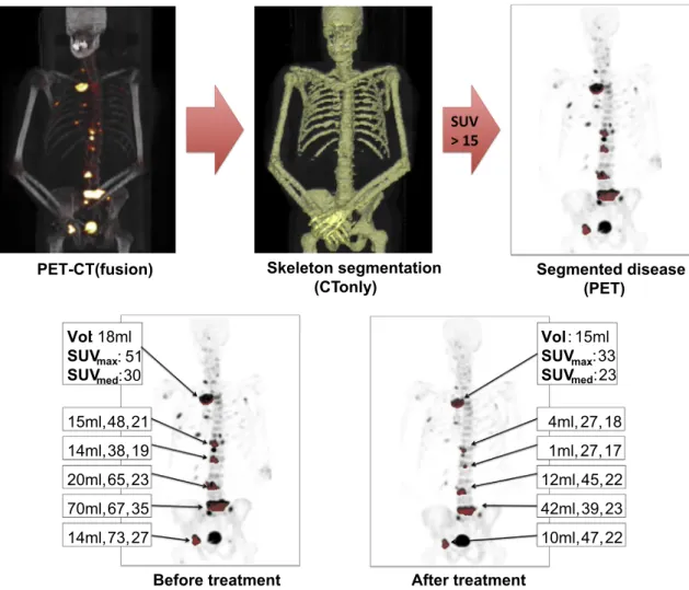 Fig. 7. OsiriX provides an ideal environment to visualise multi-modal imaging datasets, such as in this example of an 18 F-ﬂuoride PET-CT study of a patient diagnosed with metastatic bone disease from prostate cancer
