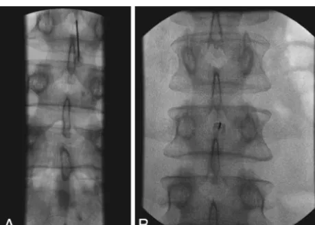 FIG 7. Cross-table lateral ﬁlm after failure to obtain CSF, thought tobe a dry tap. Note the LP approach at the L4–5 disc space and theneedle extended through the disc into the retroperitoneum