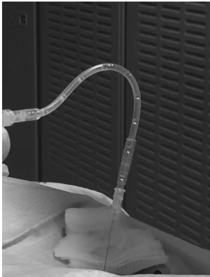FIG 9. Bubble technique to avoid sucking nerve roots into the spinalneedle. The short tubing is literally lying on the LP needle hub so thatthere is no manipulation of the needle