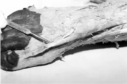 Figure 1. A photograph showing single tendinous insertion (T) of the extensor hallucis longus muscle on the dorsal aspect of thebase of the distal phalanx of the big toe.