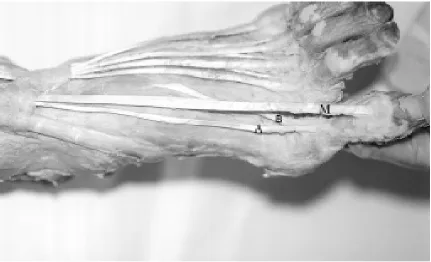 Figure 2. A photograph showing a single tendinous insertion (T) of the extensor hallucis longus muscle on the dorsal aspect ofthe base of the distal phalanx of the big toe