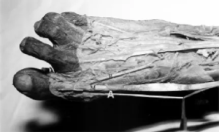 Figure 4. A photograph showing the two tendons of extensor hallucis longus muscle. The main tendon (M) is inserted into thedorsal aspect of the base of the distal phalanx of the big toe