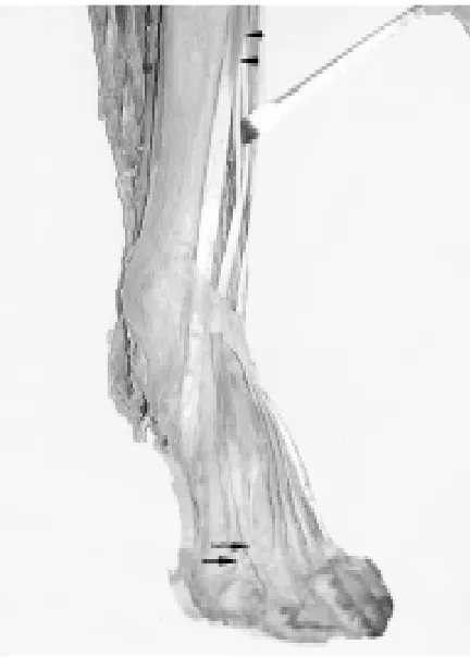 Figure 6. A photograph showing the two tendons of extensor hallucis longus muscle. The main tendon (M) is inserted into thetendon and joins the middle of extensor hallucis brevis tendon (B) forming a common tendon (C)