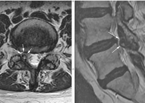 Figure 1. Axial and parasagittal FRFSE (fast relaxa-tion fast spin echo) T2 sequences show a cystic structure with hypointense rim and hyperintense content projecting ventrally from the right L4-5 facet joint and into the right lateral recess (white arrows