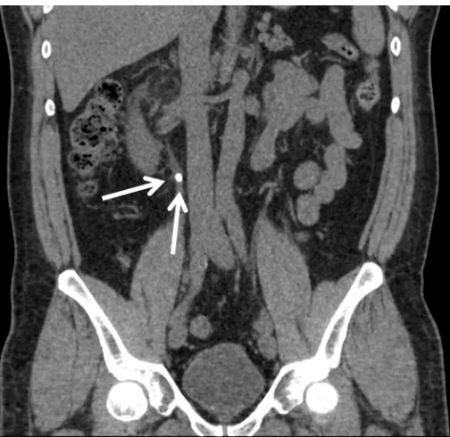 Figure 2. Axial CT indicating hydronephrosis and peri-nephric stranding in the right kidney.