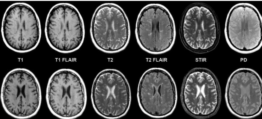 FIG 4. Multiple sclerosis in axial synthetic and conventional 3T MR imaging in a 58-year-old woman