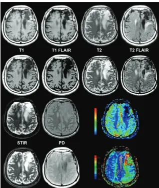 FIG 5. Chronic infarction in synthetic and conventional 3T MR imaging shown alongside colorfunctional perfusion maps in a 62-year-old man