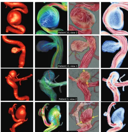 FIG 1. A, Linear correlation between the MAFA and VEL. Red dots represent cases discarded from the regression analysis due to substantialoverlap between the aneurysm and surrounding vessels in the selected DSA view