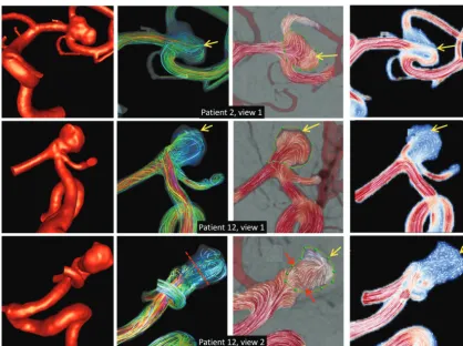 FIG 3. Top row: an example of when the DSA ﬂow visualization does not depict the intrasaccular ﬂow split