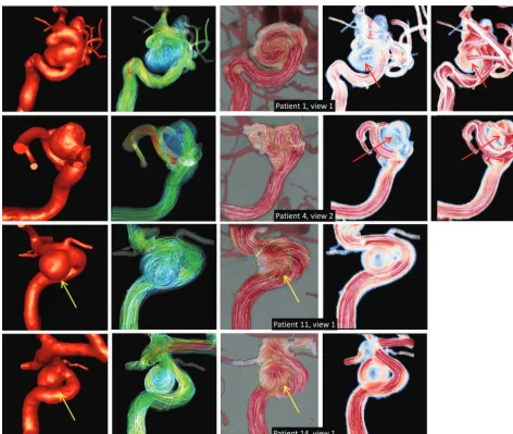 FIG 4. Examples of the effects of vessel overlaps on 4 aneurysms (rows). From left to right, columns show the following: the reconstructed CFDmodel, visualization of the 3D ﬂow ﬁeld by using streamlines, 2D DSA ﬂow ﬁeld, 2D projected MEAN CFD ﬂow ﬁeld, and