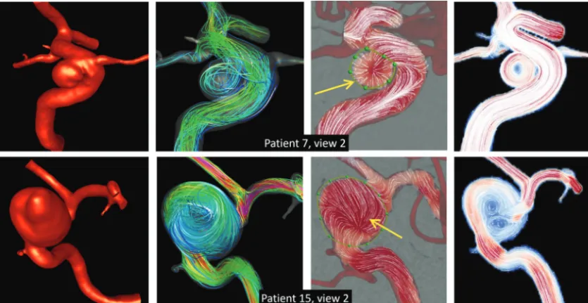 FIG 5. Examples of undersampling DSA ﬂow ﬁelds in 2 aneurysms (rows). From left to right, columns show the following: the reconstructed CFDmodel, visualization of the 3D ﬂow ﬁeld by using streamlines, 2D DSA ﬂow ﬁeld, and 2D projected MEAN CFD ﬂow ﬁeld